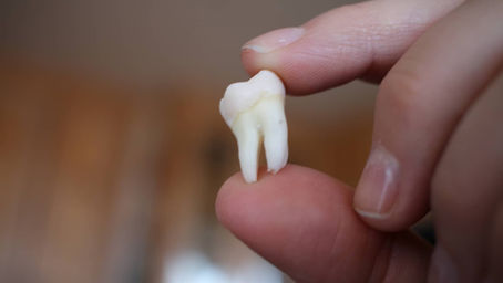 What Does Wisdom Tooth Surgery Have To Do With Our Tastebuds?