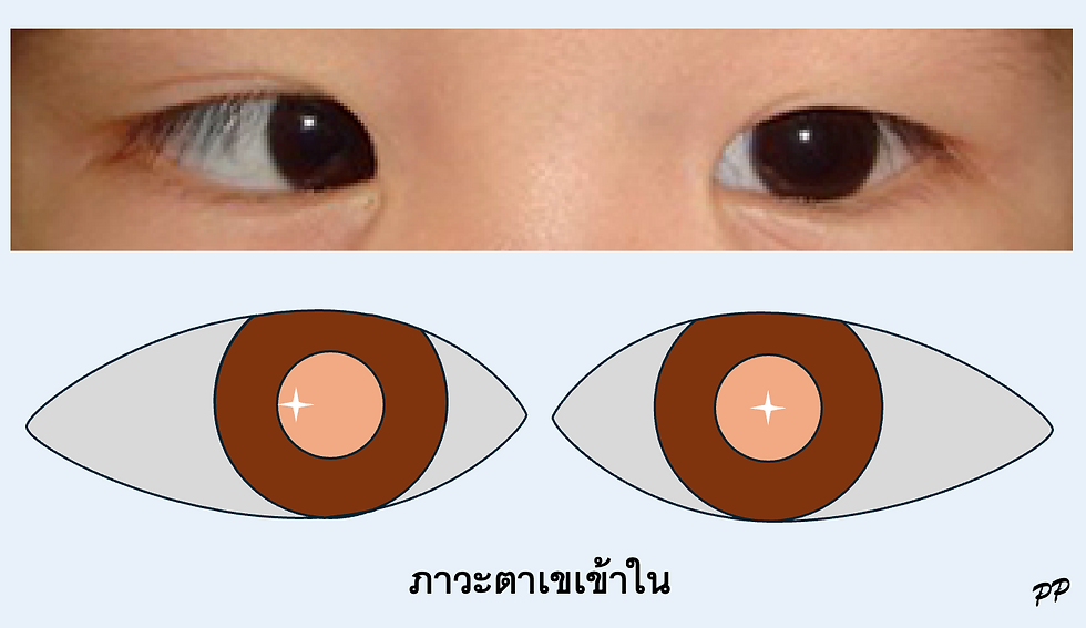 ภาพแสดงภาวะตาเขเข้าในของตาขวา สังเกตว่าแสงสะท้อนของไฟฉาย (จุดสีขาว) ที่อยู่ในบริเวณตาดำของตาซ้ายอยู่ใกล้บริเวณกลางตาดำ หมายความว่าเด็กกำลังใช้ตาซ้ายมองที่ไฟ แต่จุดสีขาวของตาขวา ไม่อยู่บริเวณกลางตาดำ แต่อยู่ใกล้ขอบตาดำ หมายความว่า ตาขวาเขเข้าใน