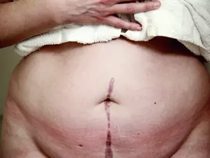 Narbenbehandlung nach Operation
