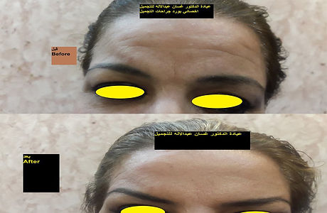 botox.jpg