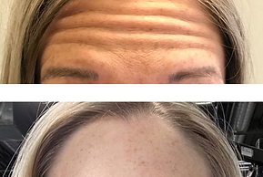 Botox Before & After