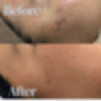 Chemical peel and skin needling