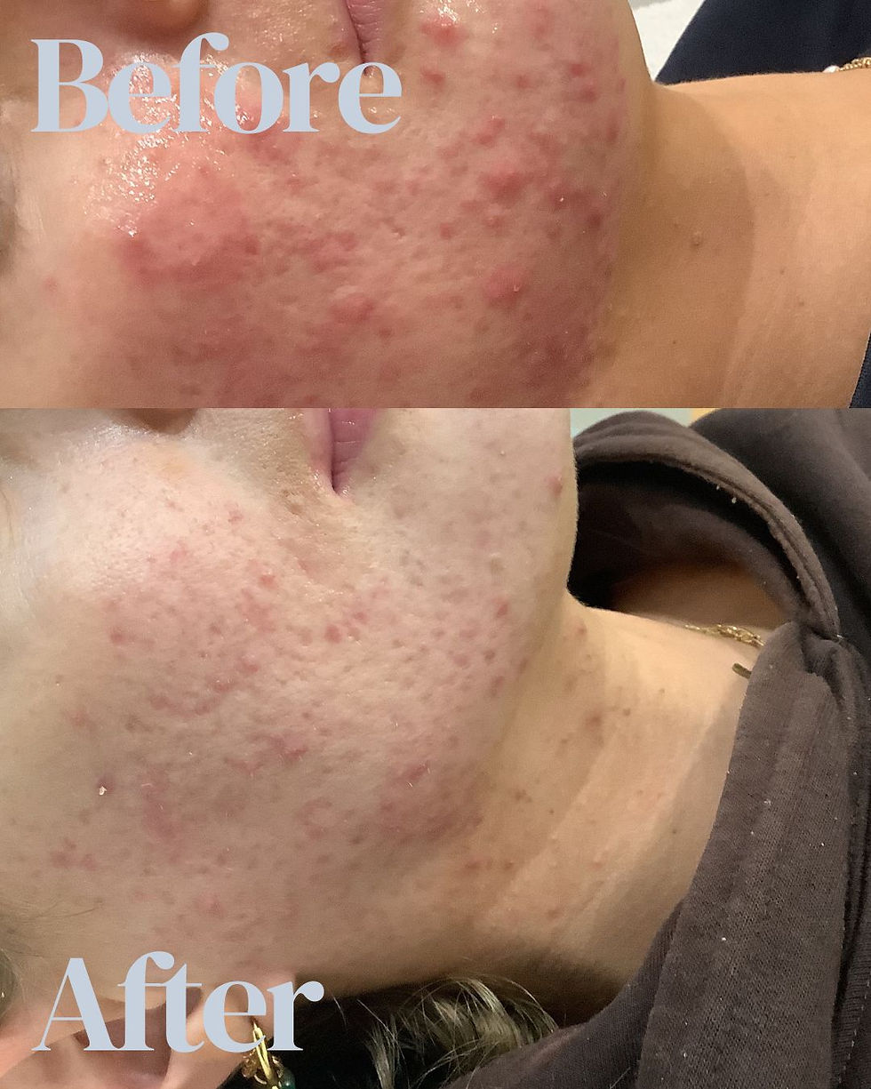 Chemical peel and one Tixel treatment