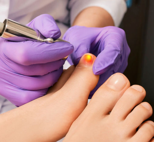 Toe nail fungus, onychomycosis, yellow toe nail