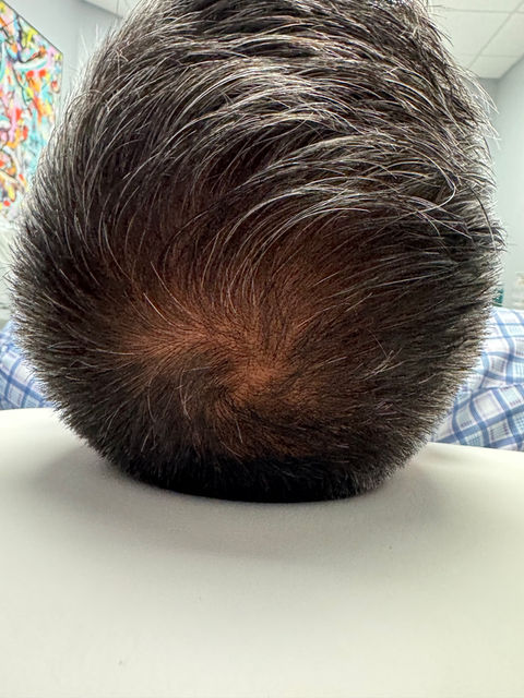 Balding
Thinning hair
Hair rejuvenation
Hair restoring
Thick hair
