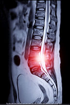 Magnetic resonance imaging or MRI of lambosacral spine or L-S spine on sagittal plane show