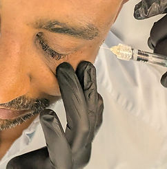 Polynucleotide injection under the eye performed by aesthetic pharmacist Shin Ru to treat skin ageing and improve hydration and elasticity.