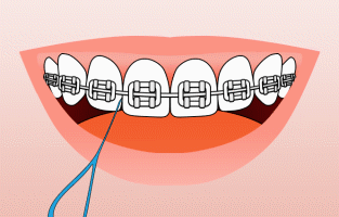 SMILE SOLUTIONS, DR. BLACK, DR ECKLER, DR LEUNG, ORTHODONTIST, BRAMPTON, MISSISSAUGA, INVISALIGN, BRACES, INVISIBLE, CLEAR