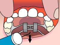 SMILE SOLUTIONS, DR. BLACK, DR ECKLER, DR LEUNG, ORTHODONTIST, BRAMPTON, MISSISSAUGA, INVISALIGN, BRACES, INVISIBLE, CLEAR