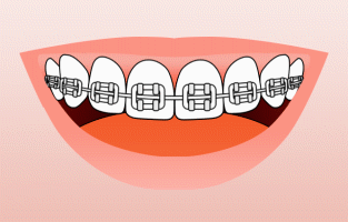 SMILE SOLUTIONS, DR. BLACK, DR ECKLER, DR LEUNG, ORTHODONTIST, BRAMPTON, MISSISSAUGA, INVISALIGN, BRACES, INVISIBLE, CLEAR