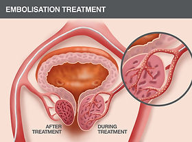 Enlarged Prostate Treatment Clinic Marbella - BPH Enlarged Prostate Treatment Clinic Marbella - BPH