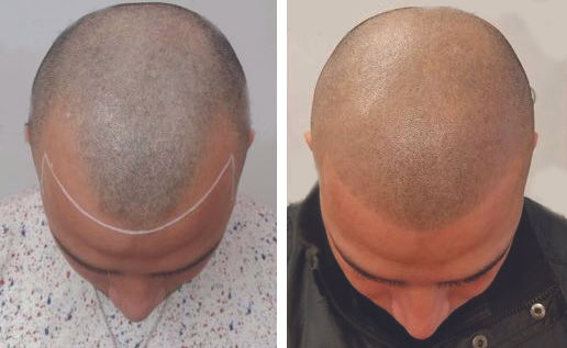 SMP Hairline before and after