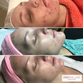 Acne treatment in Sheffield