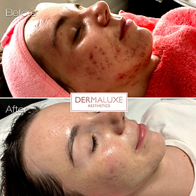 Acne treatment in Sheffield