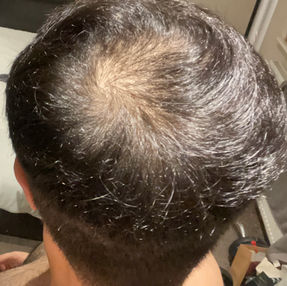 A before photo of a client who came in for some density work.jpeg
