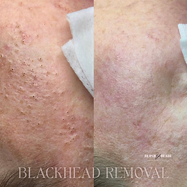 Blackhead Removal