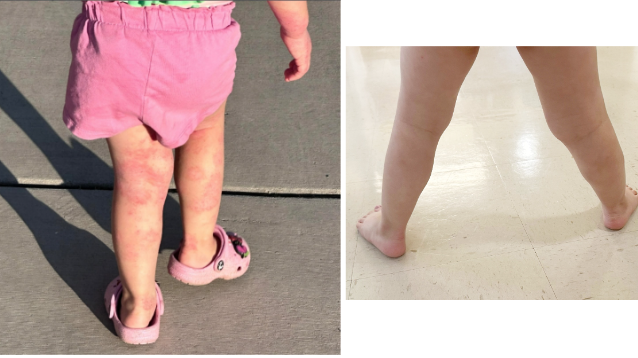 Eczema healing on toddler's legs