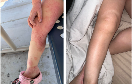 Eczema healing toddler leg