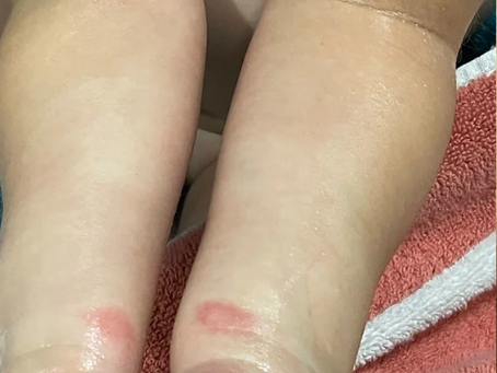Lily's Holistic Eczema Healing Journey (Before & After Pictures!)