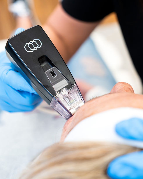 Nurse giving Morpheus8 treatment to client