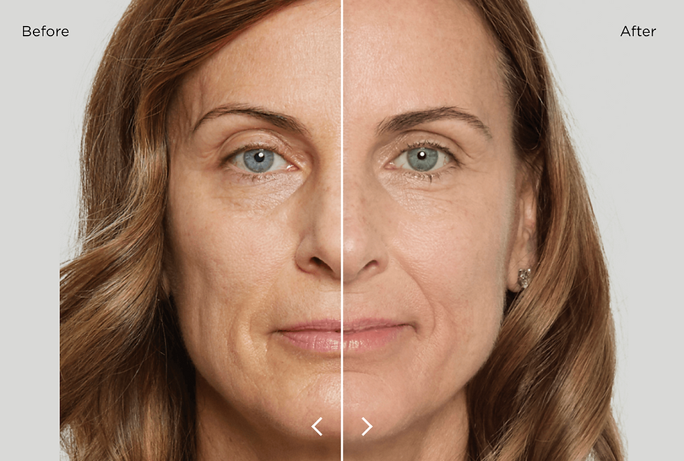 What Is Sculptra? Our New Anti-Ageing Treatment In Hampshire