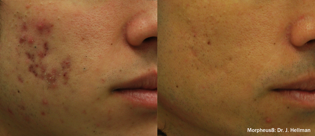 Morpheus 8 On Acne Scars