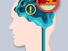 SESA llama a la prevención y detección oportuna del Ictus