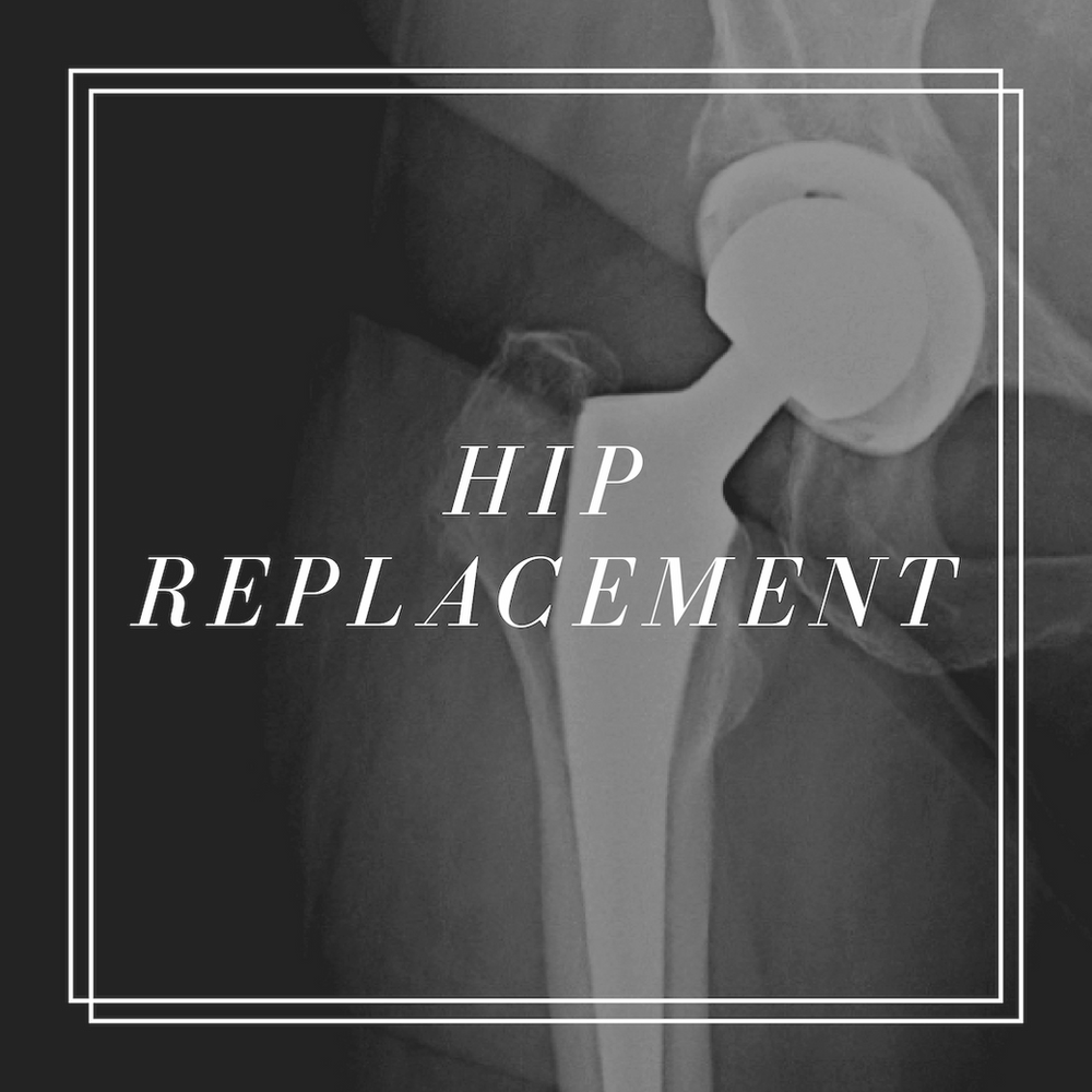 Frequently Asked Questions about Hip Replacements