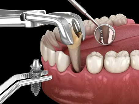 Dental Implant