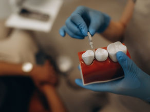 Exploring Dental Implants in San Antonio, TX: A Comprehensive Guide