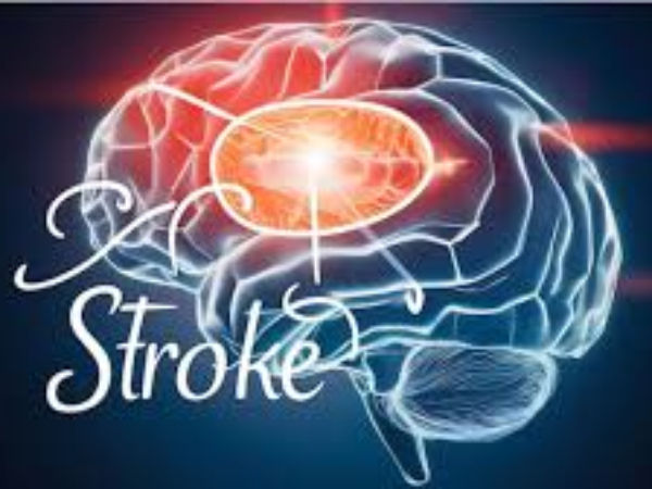 image of brain stroke