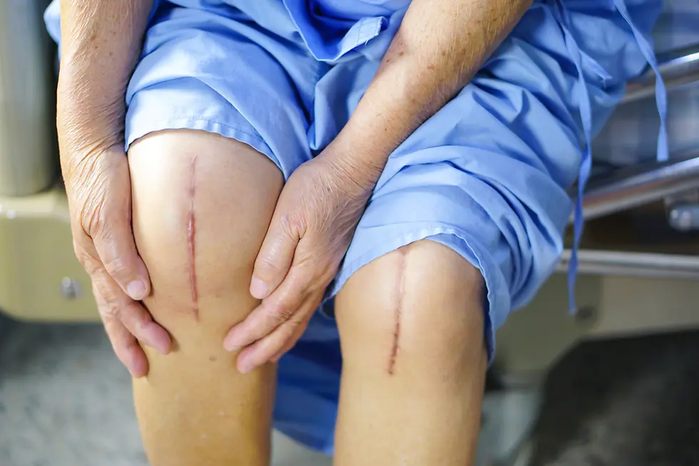 What to Expect After Knee Replacement Surgery