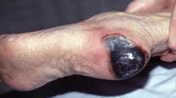 Wound Care - Wagner Grade 4 - Image 3