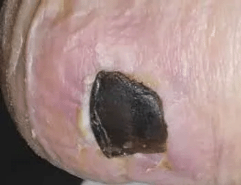 Wound Care - Wagner Grade 4 - Image 2