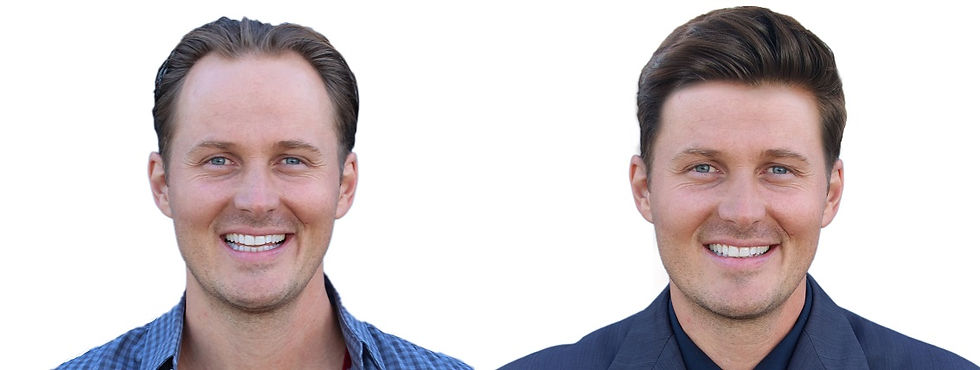 Male hair transplant before and after