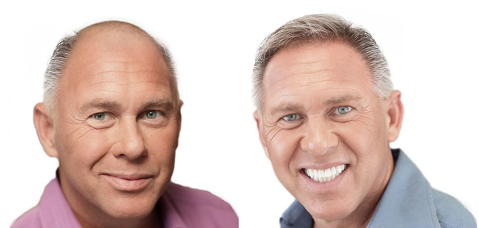 Male hair transplant before and after