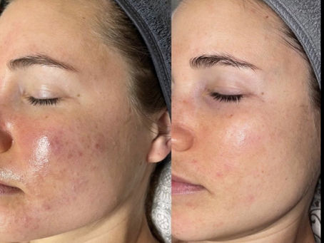 Exosomes en esthétique : le soin révolutionnaire pour la régénération de la peau