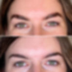 Before + After The Eye Lift Packge