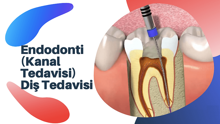 Endodonti-Kanal-Tedavisi-Diş-Tedavisi-.p