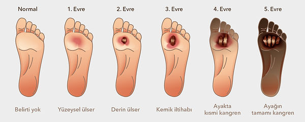 Diyabetik_ayak_yaras_C4_B1_Neden_ba_C5_9Flar.jpg