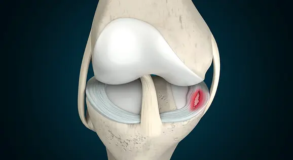 diskoid_meniskus.webp