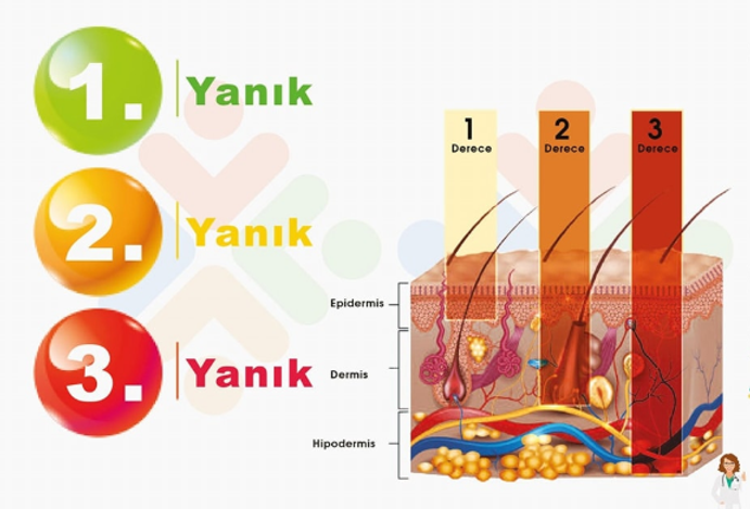 yanık.png
