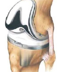 Prótesis de Rodilla