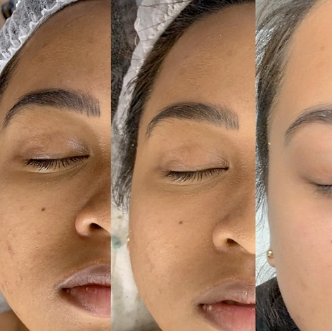 troyes Lifting sans chirurgie