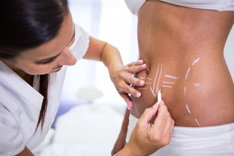 liposcultura liposuccion davel gonzalez