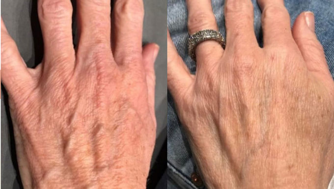 A CO2 fractional laser treatment for hands is a procedure that uses microscopic laser columns to remove a fraction of the skin's top layer, stimulating collagen production and revealing new, youthful skin. This can improve the appearance of age spots, sun damage, wrinkles, fine lines, and texture, leading to smoother, tighter-feeling skin. Recovery time can vary, but typically involves some redness, swelling, and peeling over several days to a couple of weeks.