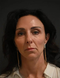 BOTOX GLOW GALA (2).png