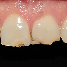 pose-couronnes-dentaires