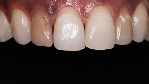 dental-crowns