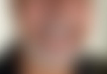 Nouveau sourire avec l'implant cortico basal en France